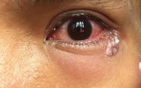 shingles left eye